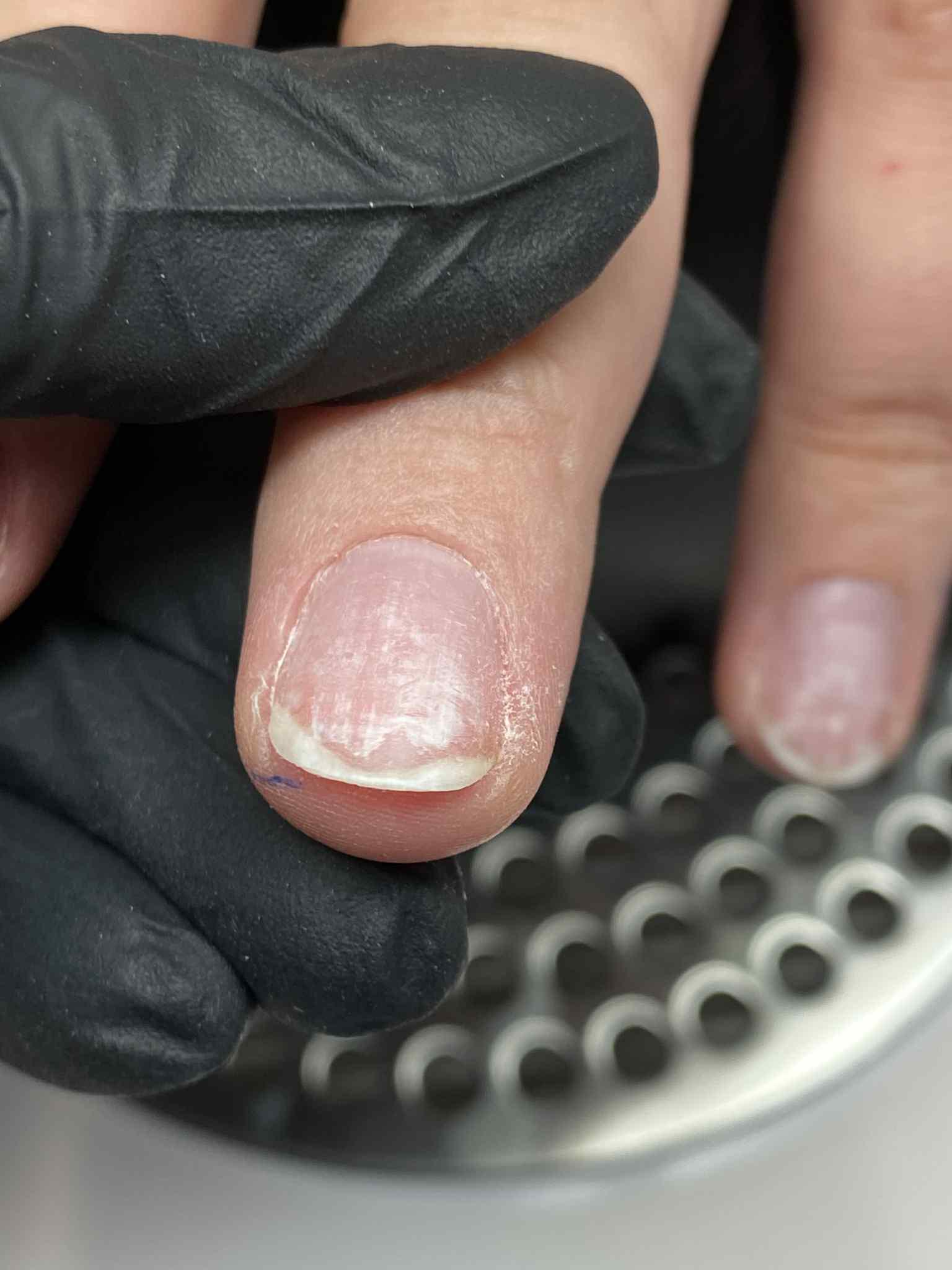 Białe plamki na naturalnym paznokciu