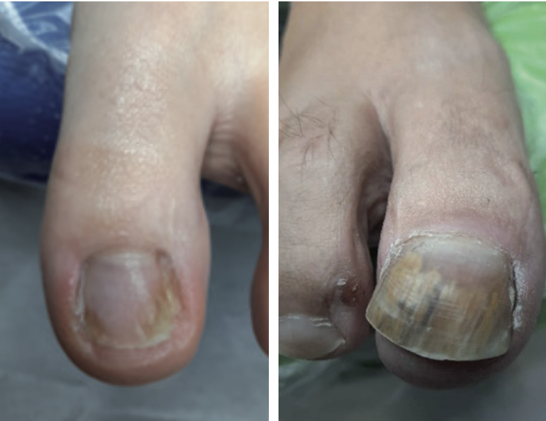 Grzybica paznokci wywołana przez dermatofity (różne fazy zaawansowania) – z praktyki własnej Milena Skalska 