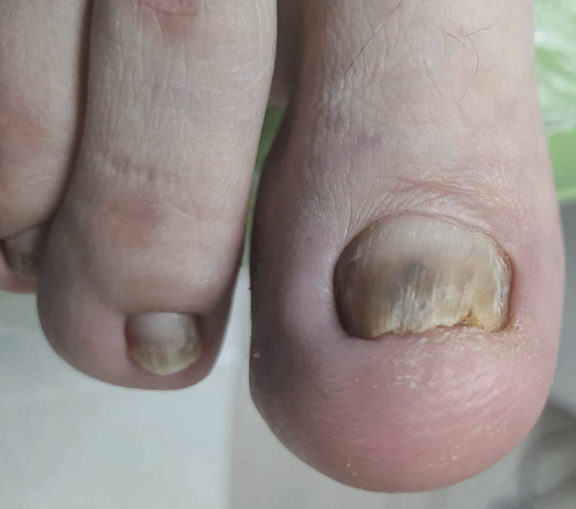 Łuszczyca paznokci u stóp
