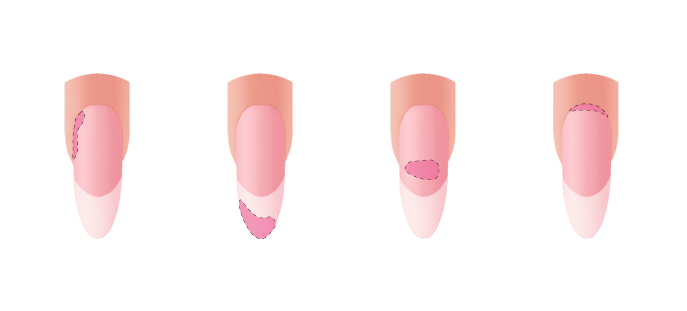 Możliwe umiejscowienia liftingu