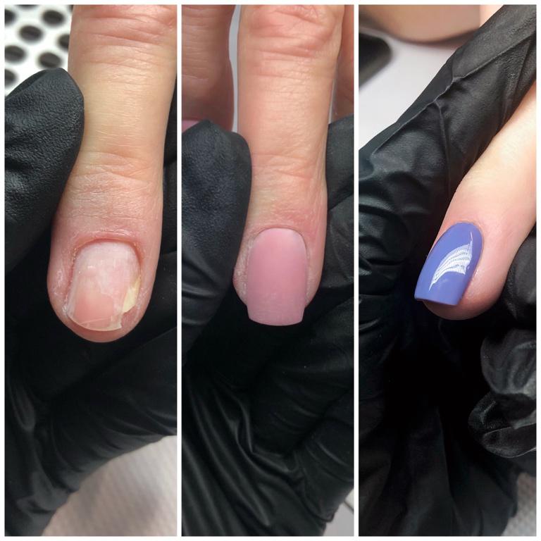 Onycholiza – rekonstrukcja paznokcia 