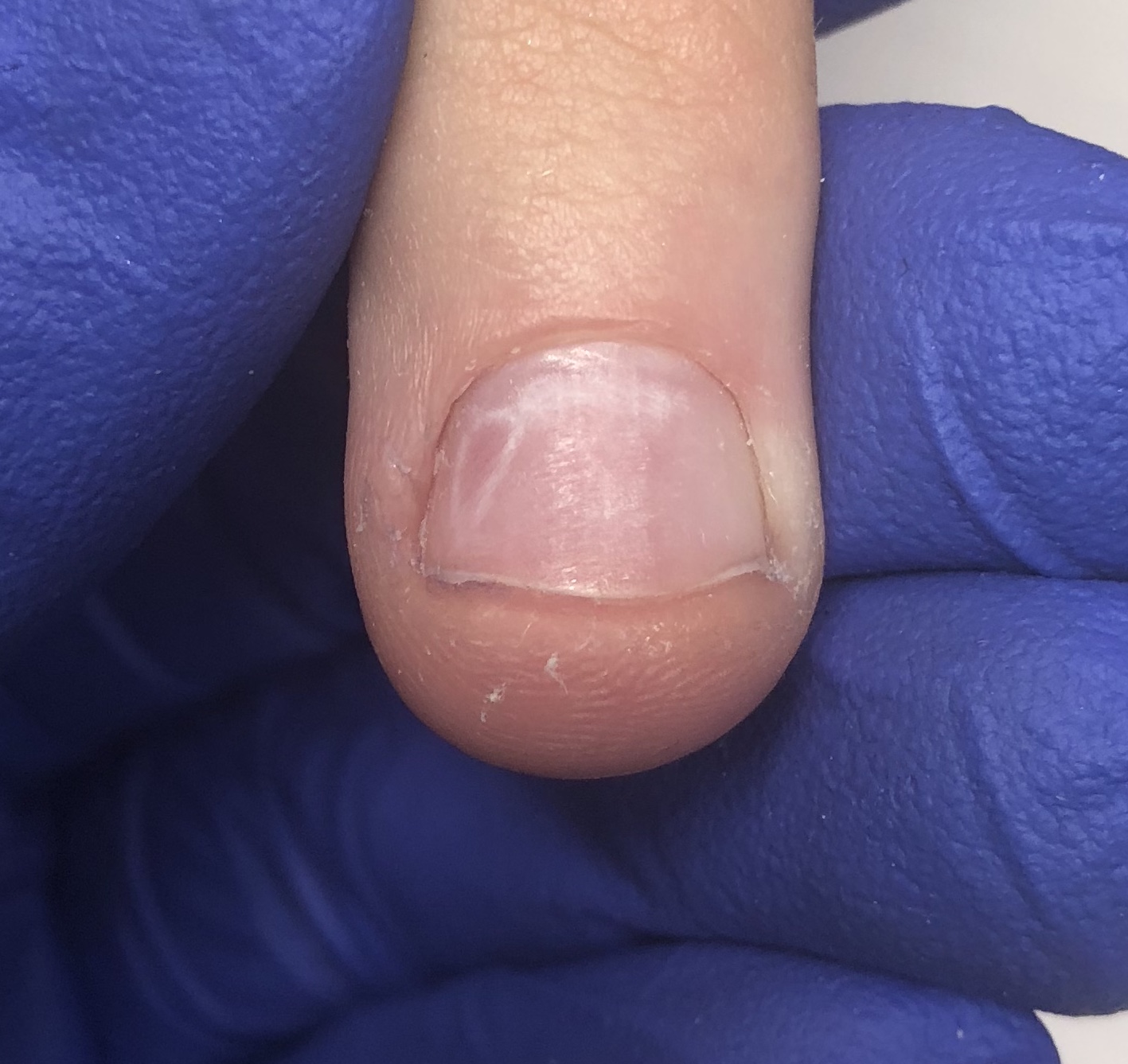 Przepiłowana płytka paznokcia