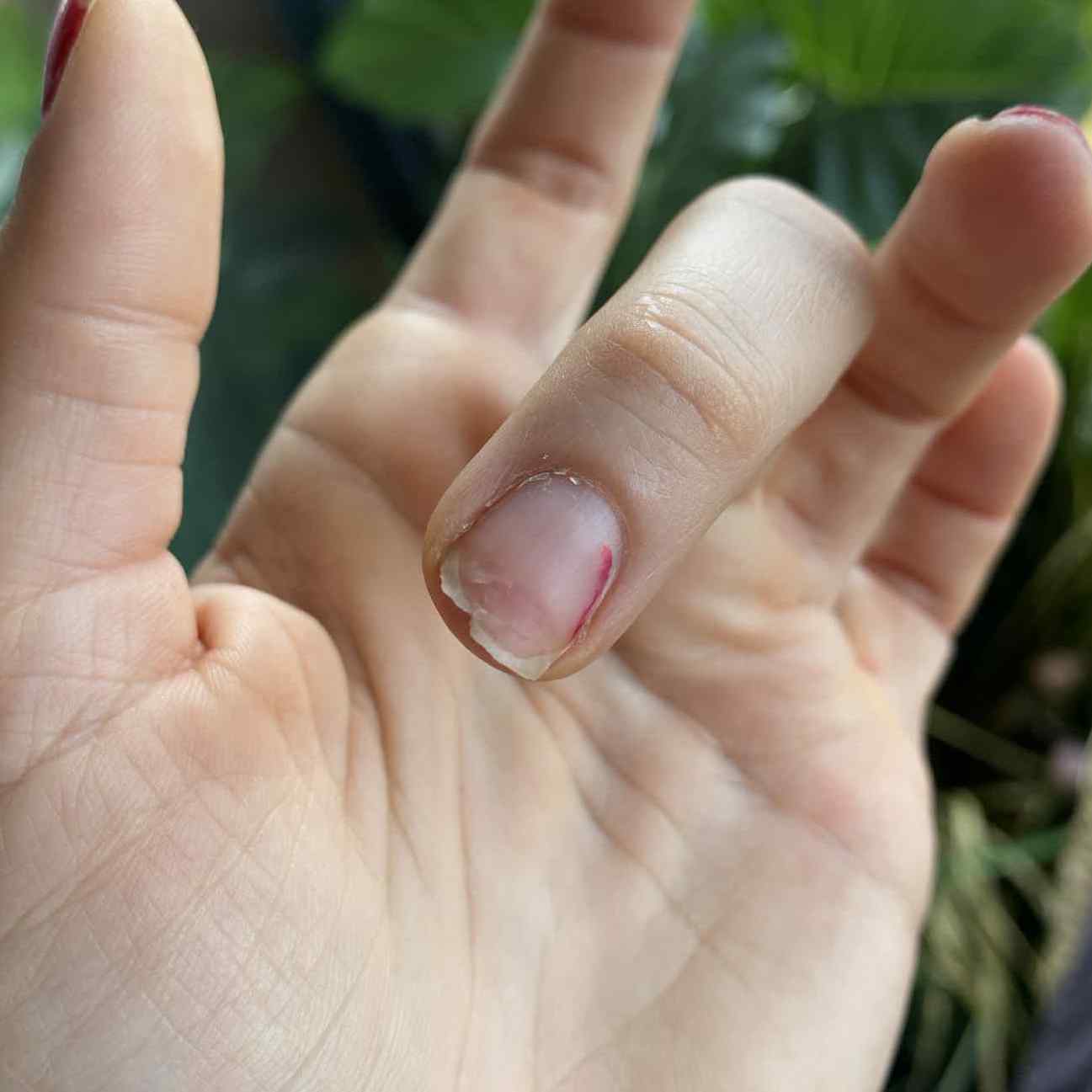 Przepiłowany paznokieć, w którym coraz bardziej zaczyna prześwitywać łożysko