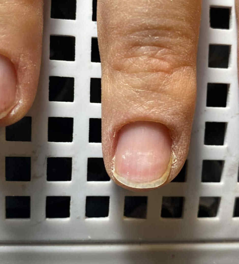 Wydatne fałdy lateralne i lekko nabrzmiały fałd proksymalny